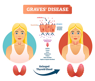Graves’ Disease